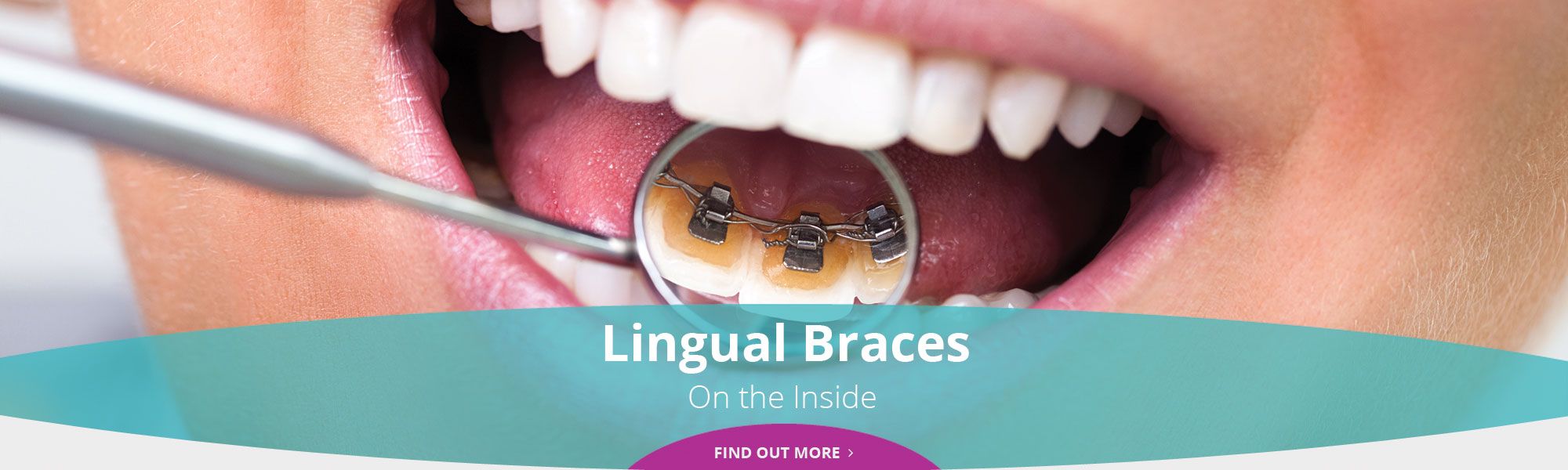 Lingual Braces - On the Inside - Find out more