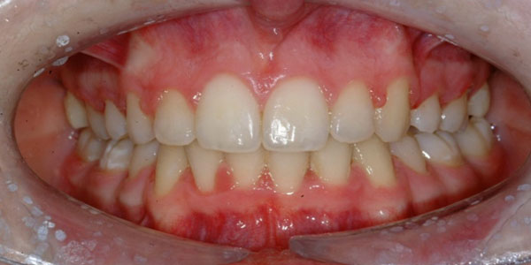 Patient after dental treatment